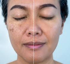 Dark Skin and Dull Face? Best Skin Whitening Cream in Pakistan That Works Fast